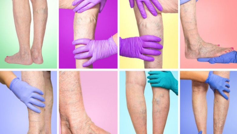 Treatment for Varicose Veins in Legs