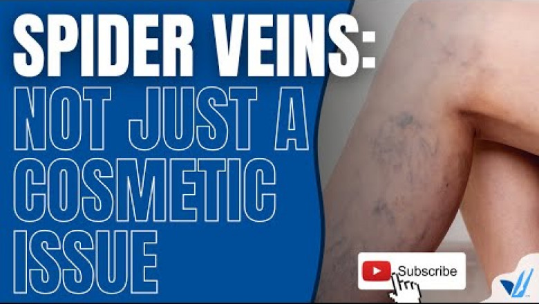 Spider Veins: More Than Just A Cosmetic Condition