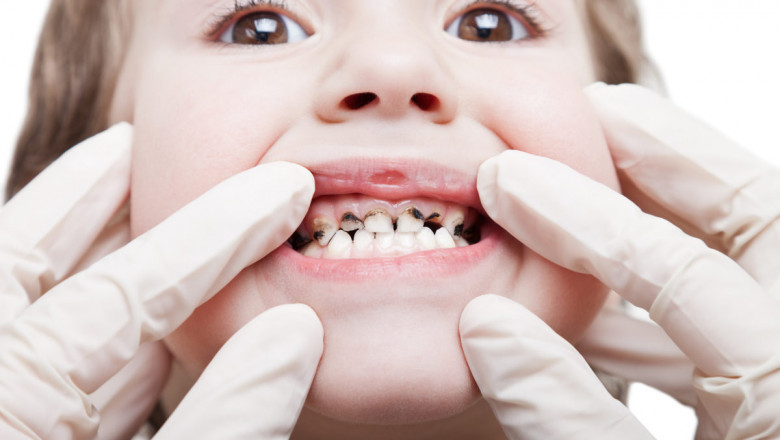 Tooth Decay Treatments For Kids