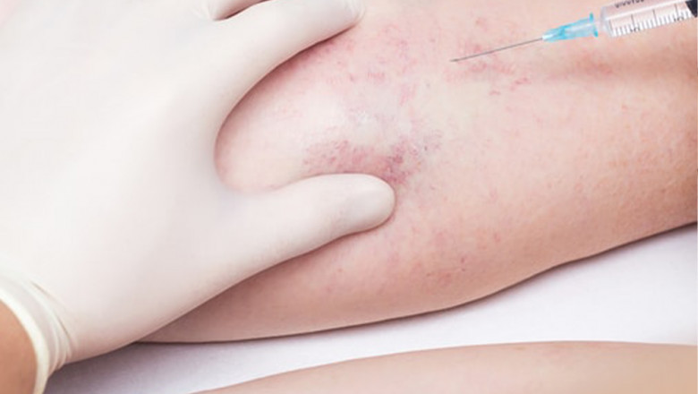 What conditions are treated by Vascular Surgeons?