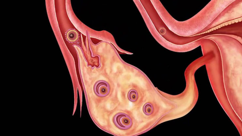 Lifestyle Changes for Polycystic Ovary Syndrome Treatment