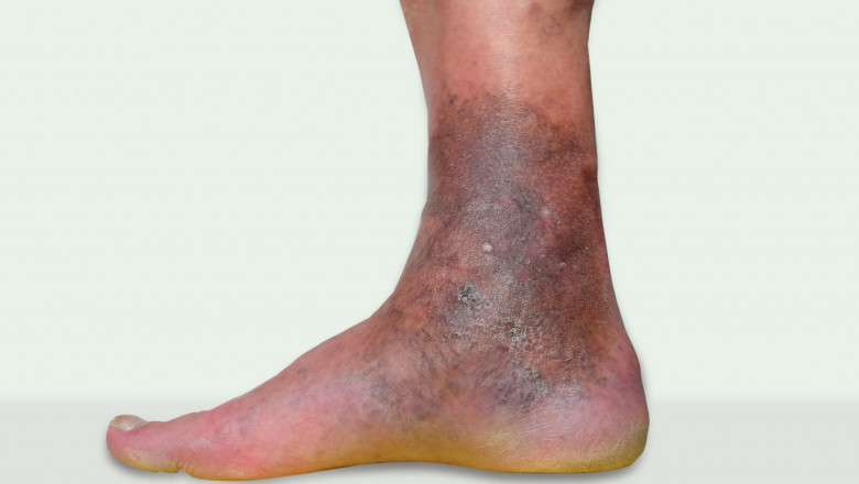 Venous Ulcer Specialist