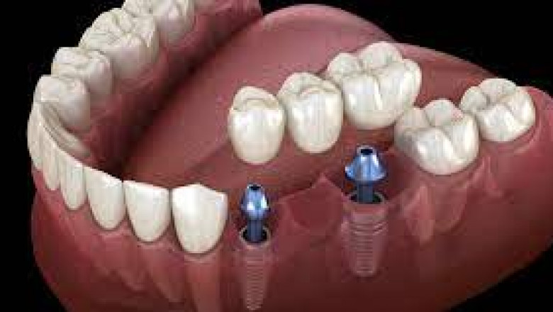 Amazing Benefits of Using Dental Crown