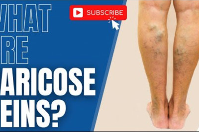 Varicose veins are bulging, prominent veins in your legs