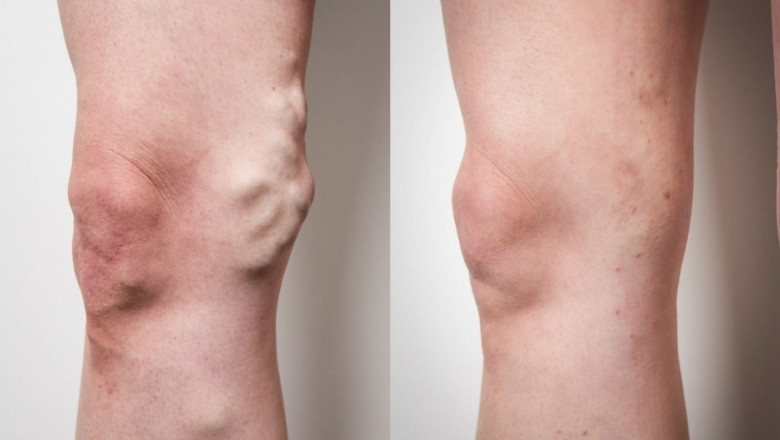 A complete guide about varicose veins