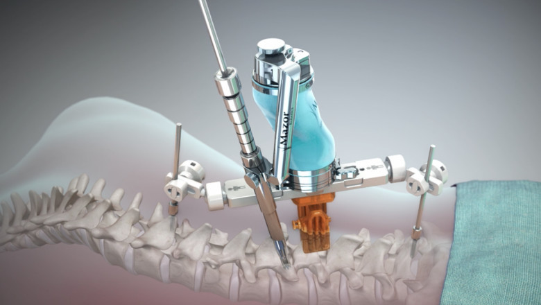 Spine Surgery Devices Market Growth Drivers, Forecast analysis 2020-2028