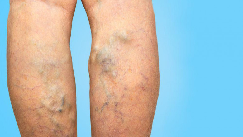 What Are Varicose Veins And Spider veins?