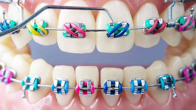 What Types Of Power Chains Are Available For Braces?
