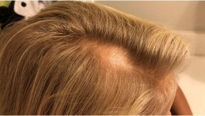 Children’s hair loss causes and treatments