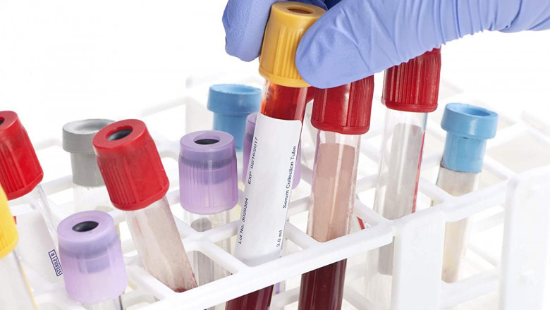 Analysis of the Global Blood Collection Tubes Market - Global Industry Insights, Trends, Outlook, and Opportunity, 2022-2028