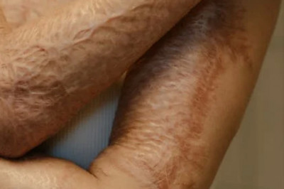 How Can Burn Injury Attorneys Help?