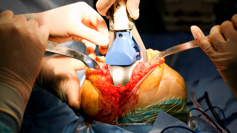 Knee Replacement Surgery in Dubai - Dr RIk Kundra