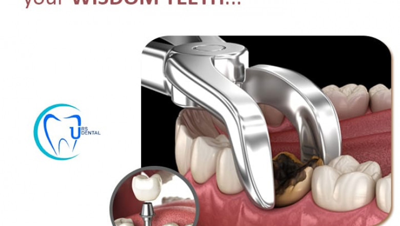 protect your teeth by safely extracting your wisdom teeth