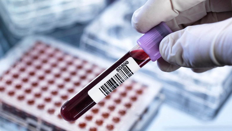 Cancer Biomarkers Tested Using Body Tissue Samples, Blood Samples, Or Other Physiological Fluids