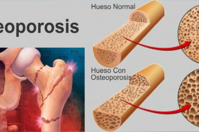 Osteoporosis Drugs Market Growth Insights and Forecast Analysis, 2020-2027