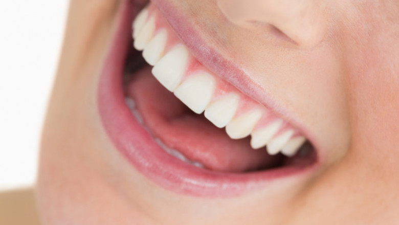 Accomplish That Hollywood Smile With Veneers In Dubai