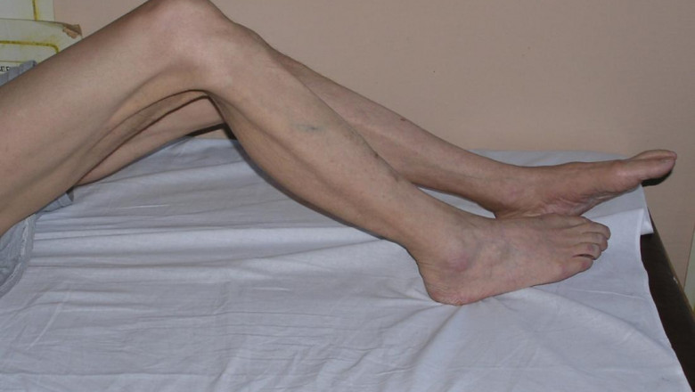 Everything You Need To Know About Muscle Atrophy