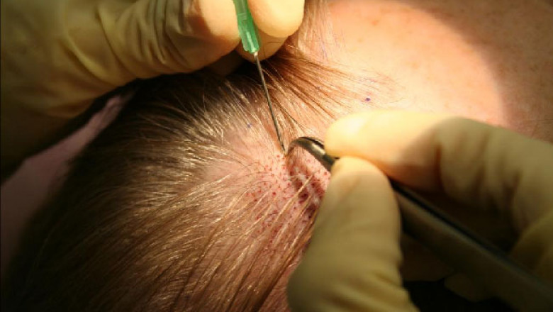 How sapphire hair transplant gives expected results to the patients?