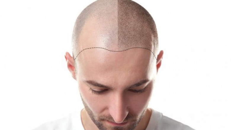 Things To Be Considered Before Undergoing Hair Transplant Surgery