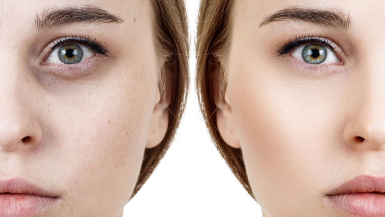 Top Tips to Care for Dark Circles and Sunken Eyes