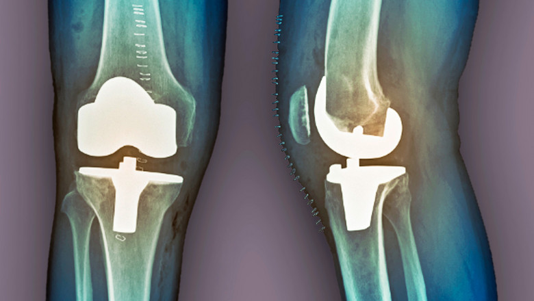An Overview on Knee Surgeries and Arthroplasty Pain Management Therapeutics