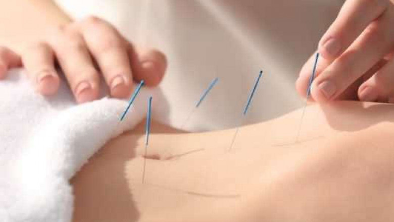 Pain Management - Amazing Benefits you get from Cosmetic Acupuncture