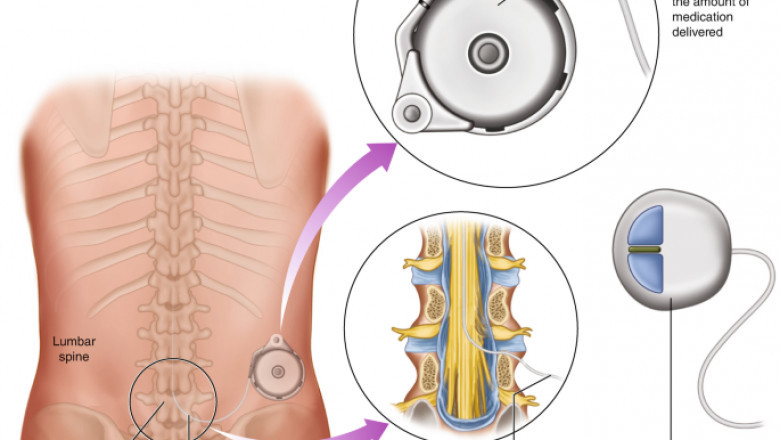 Intrathecal Pumps Are Implants That Are Placed Surgically Under The Skin