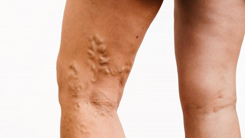 Varicose veins treatment guide