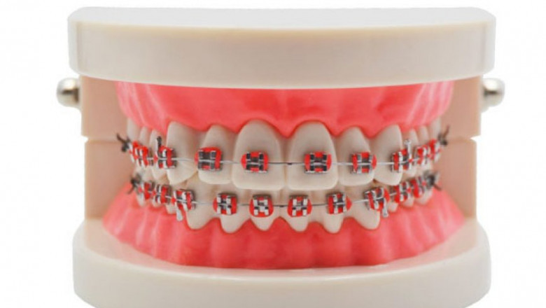 What Are The Best Braces Color Combinations For Summer?