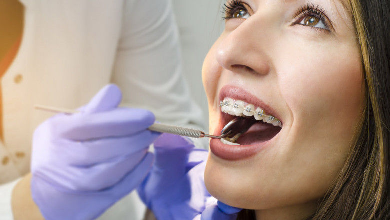 Braces in London Ontario