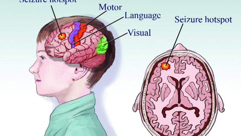 What is Epileptic Seizures Treatment consist of?