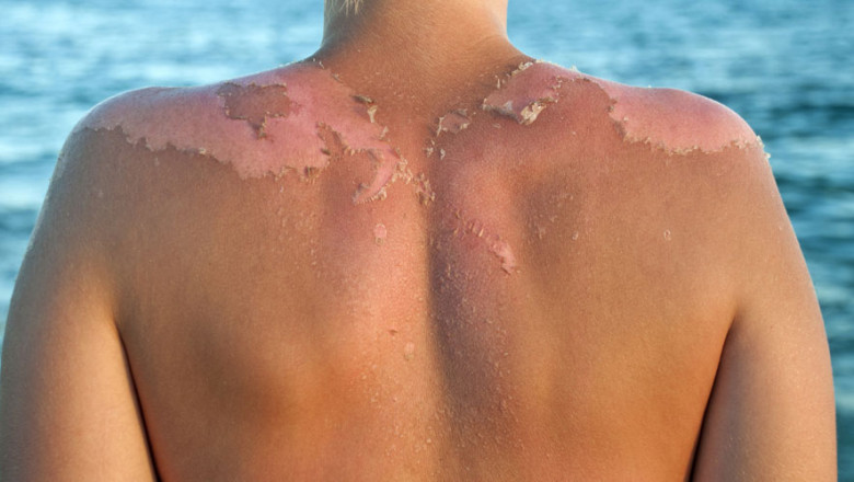 How to get rid of peeling skin?