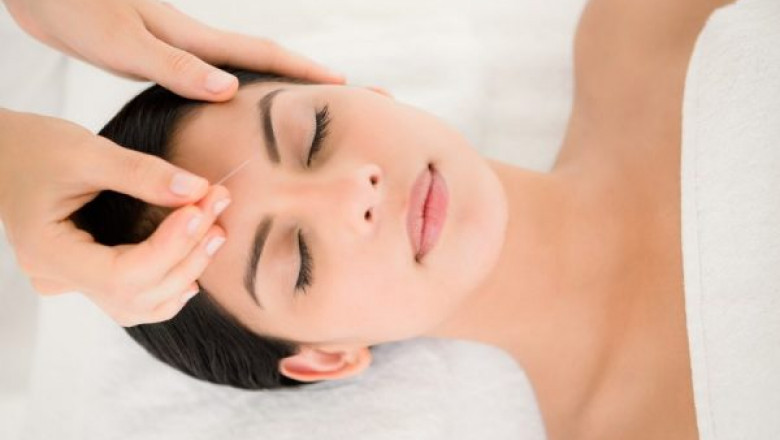 Cosmetic Acupuncture - Laser acupuncture Mount Pleasant