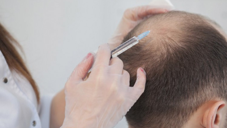 Hyperthyroidism and hair loss.