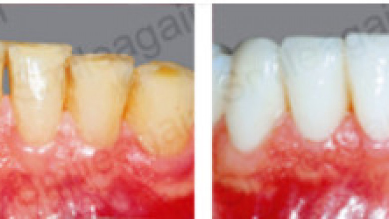 SMILE DESIGNING IN MUMBAI