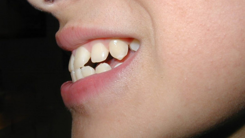 What Is The Best Method To Fix Overbite?