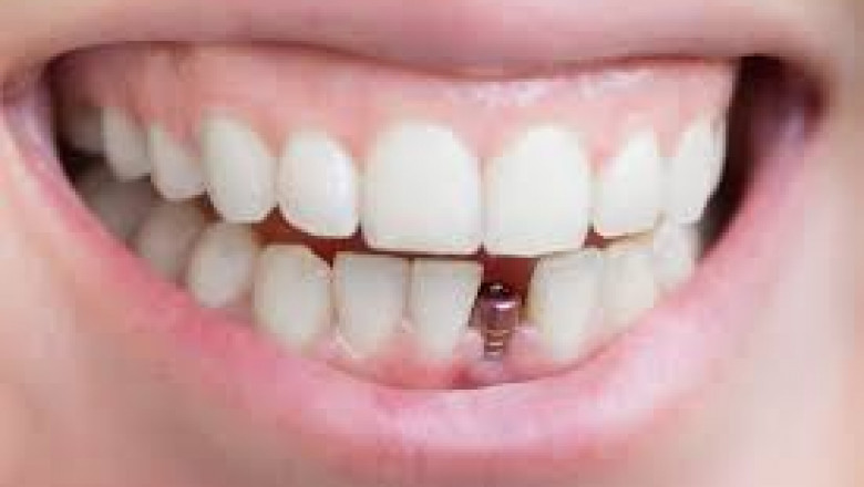 What Role Do Dentures Play In Dentistry?