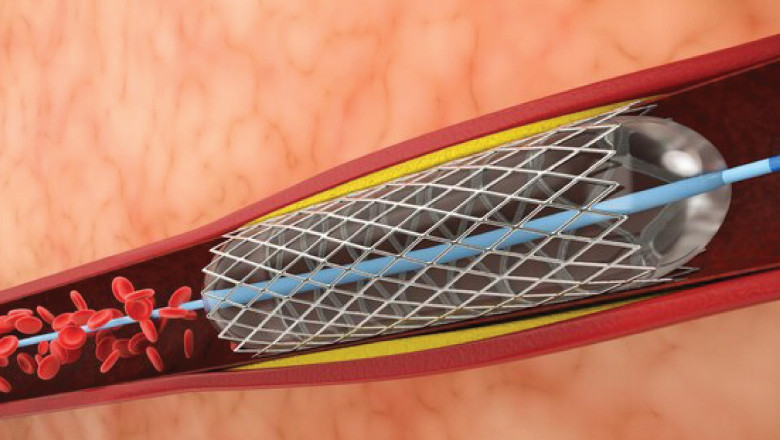 Fractional Flow Reserve Market Trends, Comprehensive Analysis, Company Latest News and Forecast to 2028