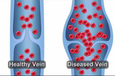 What Healthy Veins Vs. Diseased Veins Look Like