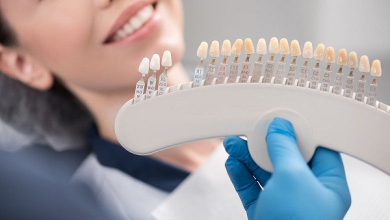 How Long Will Veneers Last?