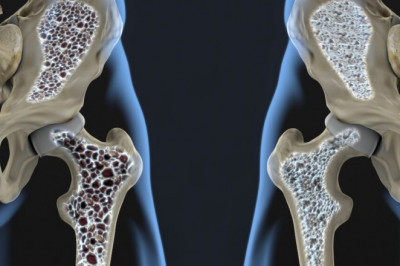 Can Osteoporosis Drugs hurt your bones?