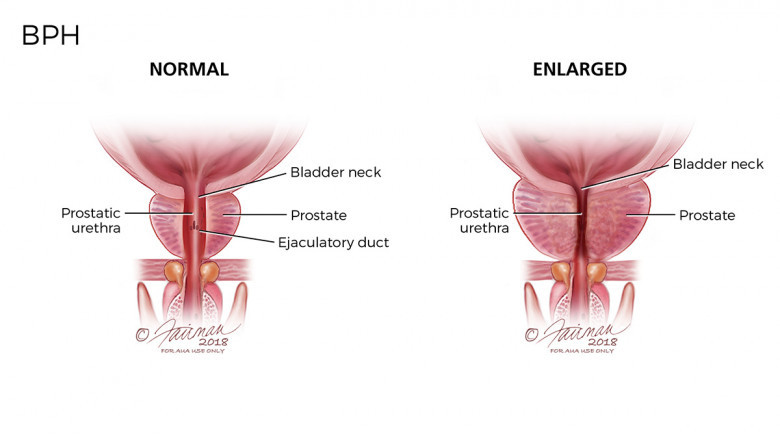 What is benign prostatic hyperplasia?
