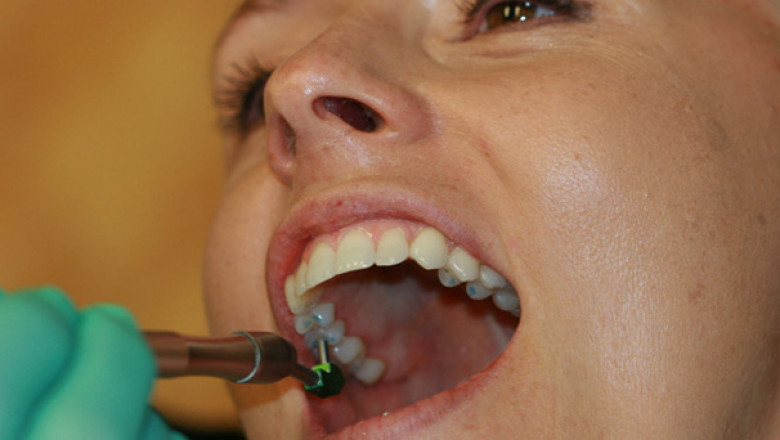 Professional Dental Implant Service in Sunrise FL
