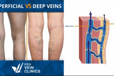 Are All Varicose Veins Visible?