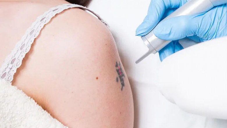 Picosure vs Q Switch Laser For Tattoo Removal Before And After