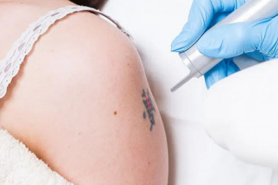 Picosure vs Q Switch Laser For Tattoo Removal Before And After