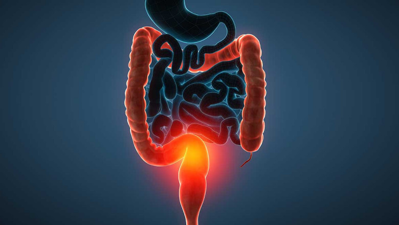 Ulcerative Colitis is a Serious Condition that Causes a Variety of Symptoms Ranging from Mild to Severe