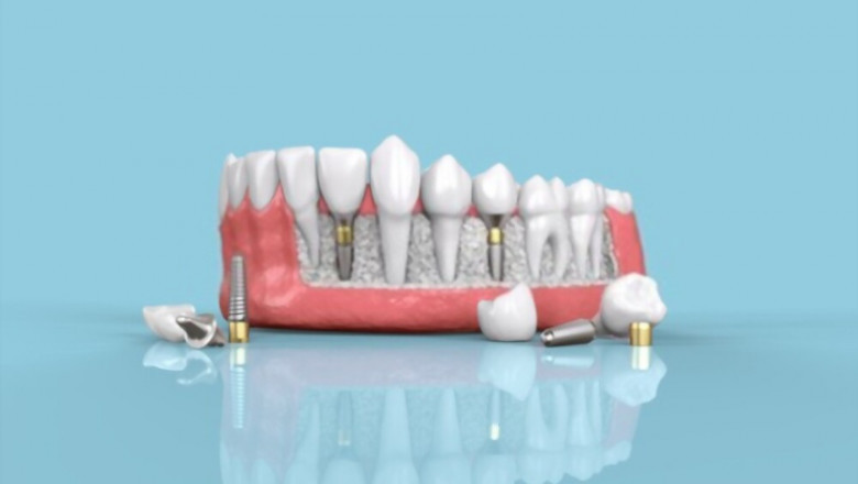 What to Expect During Dental Implant Treatment?
