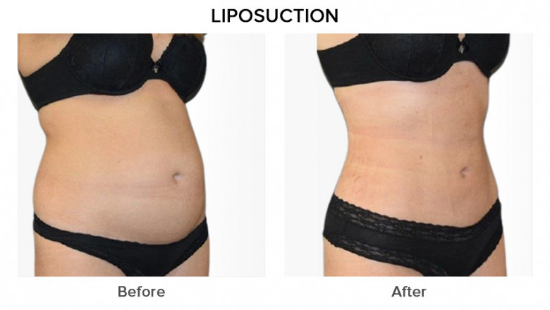 Cost of Liposuction Surgery in Delhi