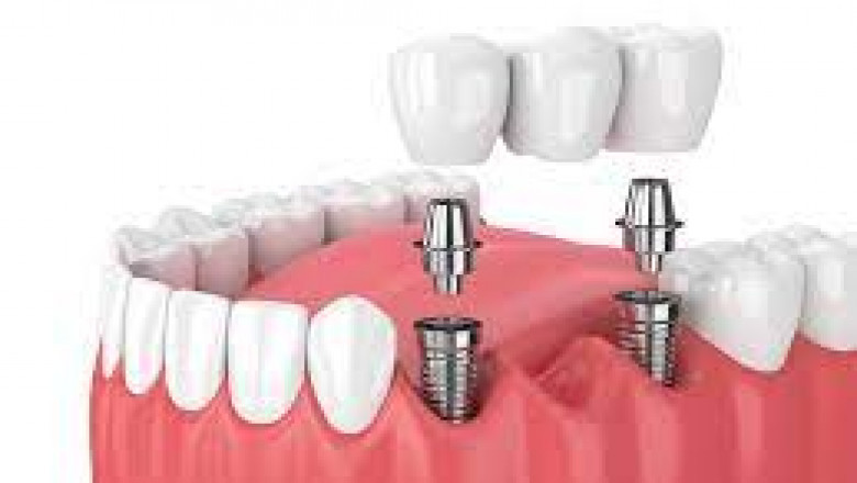Will Dental Fillings Cure The Cavity?